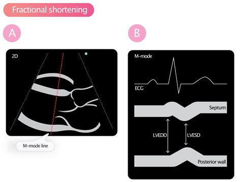 lv function|fractional shortening vs ejection fraction.